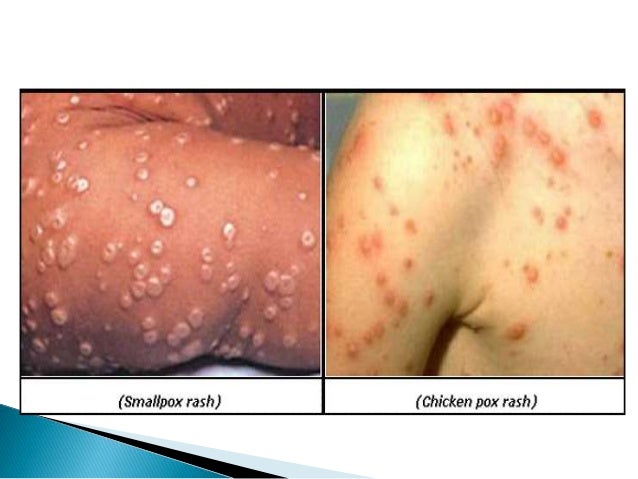 That would rash after fever adult can All rash after fever adult